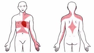 Širenje boli u prsima uslijed angine pektoris ili prilikom srčanog udara